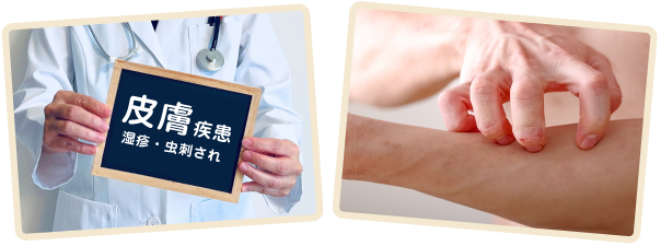 皮膚疾患 湿疹・虫刺され